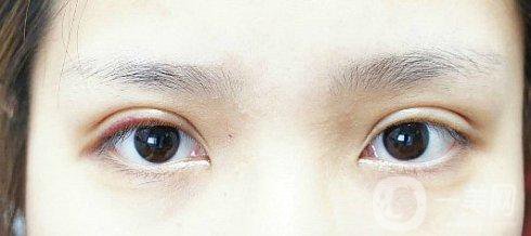 眼睛埋線幾年后的危害有些什么？