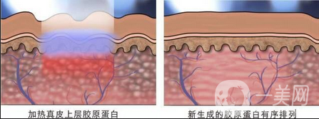 做像素激光調(diào)節(jié)痘疤一般多少錢？