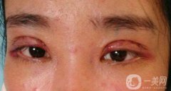 做完韓式三點(diǎn)雙眼皮之后眼睛會(huì)腫嗎？
