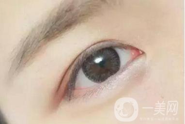 做完韓式三點(diǎn)雙眼皮之后眼睛會(huì)腫嗎？