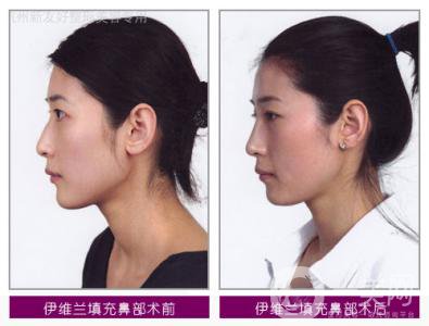 伊維蘭除皺多少錢 價(jià)格是多少？