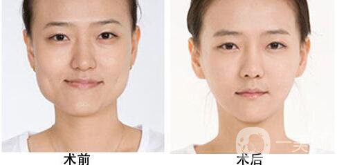 磨下頜角,價格