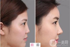 隆鼻手術(shù)有危險(xiǎn)嗎 *嗎？