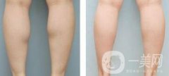 注射瘦腿*果嗎、注射瘦腿有副作用嗎