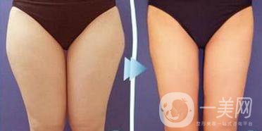 溶脂減肥手術(shù)的價(jià)格一般多少錢(qián)？