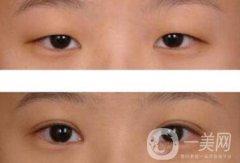 威海割雙眼皮多少錢？雙眼皮手術價格詳解
