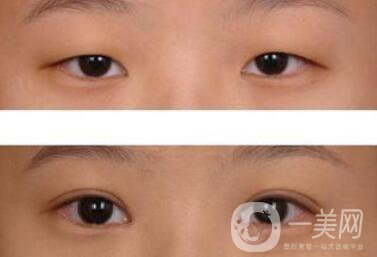 威海割雙眼皮多少錢？雙眼皮手術(shù)價(jià)格詳解