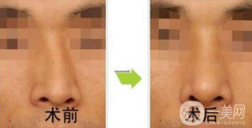矯正鼻子大概多少錢？矯正鼻子多少費(fèi)用詳情