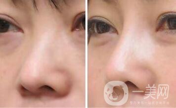 上?？s小鼻頭手術(shù)多少錢 縮小鼻頭整形價格介紹