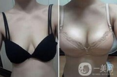 娜高假體隆胸多少錢 上海娜高假體隆胸價(jià)格詳解