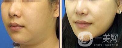 等離子激光溶脂價(jià)格、大概需要多少錢