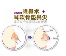 北京耳軟骨墊鼻尖價(jià)格 北京耳軟骨墊鼻尖多少錢(qián)