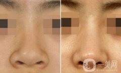 深圳鼻翼縮小多少錢能做 鼻翼縮小手術(shù)價(jià)格詳解