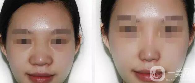 深圳鼻翼縮小多少錢能做 鼻翼縮小手術(shù)價格詳解