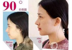 鼻子矯正費(fèi)用 歪鼻矯正多少錢(qián)