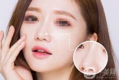 北京自體脂肪隆鼻多少錢(qián) 北京自體脂肪隆鼻價(jià)格介紹