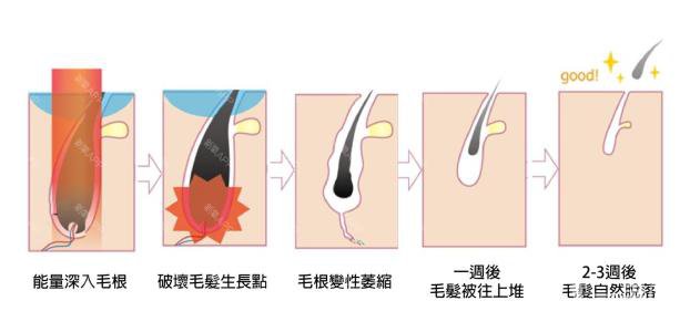 做一次激光脫毛的價(jià)格大概要多少錢？