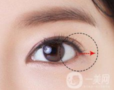 做完開眼角手術(shù)之后果明X嗎？