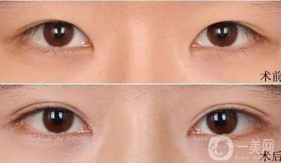 割雙眼皮,注意事項