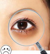激光黑眼圈術(shù)后護(hù)理 激光去黑眼圈注意事項