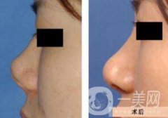 上海鼻小柱延長(zhǎng)價(jià)格 鼻小柱延長(zhǎng)手術(shù)多少錢