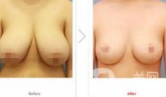 乳房縮小手術(shù)*嗎 乳房縮小有風(fēng)險(xiǎn)嗎