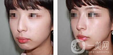 鷹鉤鼻矯正注意事項詳細(xì)介紹 鷹鉤鼻矯正如何護理