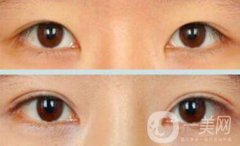 割雙眼皮疼不疼？打了麻藥還疼嗎？