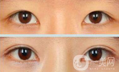 割雙眼皮疼不疼？打了麻藥還疼嗎？