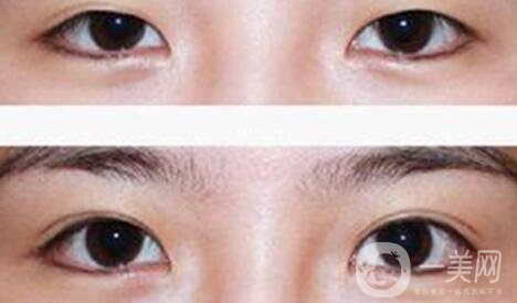 割雙眼皮疼不疼？打了麻藥還疼嗎？