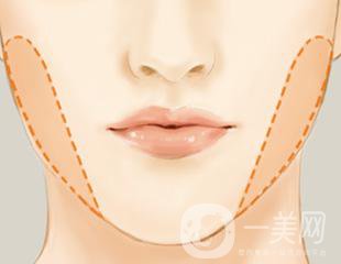 去頰脂墊多久恢復(fù) 與哪些因素有關(guān)？