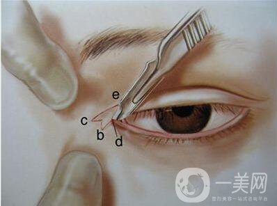 韓式開眼角價(jià)格 韓式開眼角多少錢