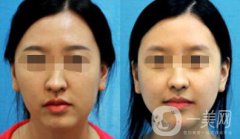 歪鼻矯正的危害 歪鼻矯正術(shù)后護理詳細(xì)介紹