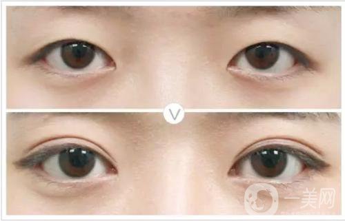 割雙眼皮和埋線哪個(gè)*果比較好？