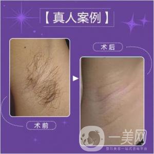 激光脫毛多少錢一次比較合理？