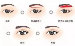 廣東眉整形價格多少 眉整形要多少錢