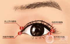 什么人適合做開(kāi)眼角手術(shù)？