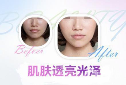 果酸換膚的功* 有哪些好處？