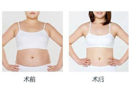 360度環(huán)形吸脂有哪些術(shù)后注意事項(xiàng)？