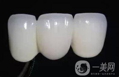 貴金屬,烤瓷牙,多少錢(qián)