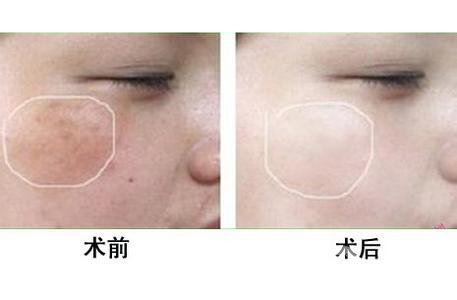 *風(fēng)范祛斑多少錢一次 與哪些因素有關(guān)？
