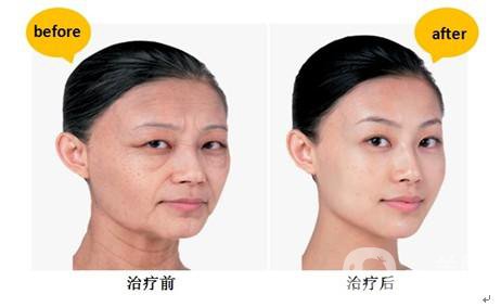 *生物除皺*果怎么樣？能持續(xù)多久？