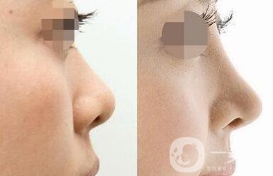 *術后注意事項 *整形術后如何護理