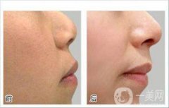 光子嫩膚前后*果嗎 果怎么樣？