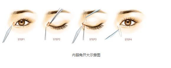 做開內(nèi)外眼角手術(shù)需要多少錢？