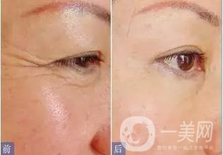 *去魚尾紋*嗎 *果怎么樣？