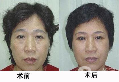 熱瑪吉除皺*果怎么樣？有哪些優(yōu)勢？