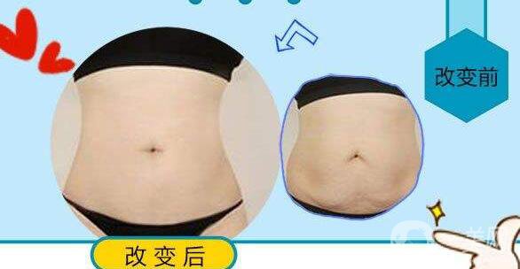 吸脂,多少錢