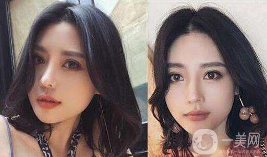 下頜角截骨手術(shù)費(fèi)用需要多少？