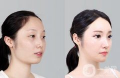 磨腮削骨多少錢？腮幫子磨骨多少錢？